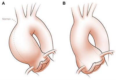 Pathogenic Mechanisms of Bicuspid Aortic Valve Aortopathy